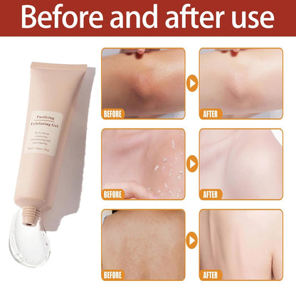 ClearSkin Exfoliating Gel - Get Rid of Skin Impurities that Cause Darkening